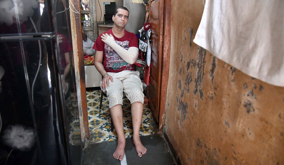 Long-drawn battle: Manoj Wadhwa of Mumbai developed swelling in his limbs after undergoing surgery for breast cancer | Janak Bhat Long road to recovery
