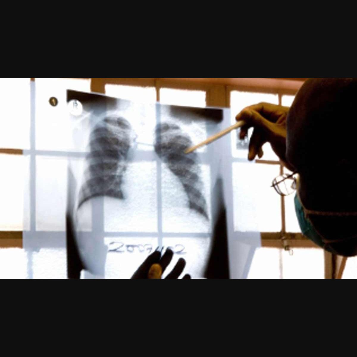 New TB drugs, old challenges: Experts warn of MDR-TB crisis in HIV patients