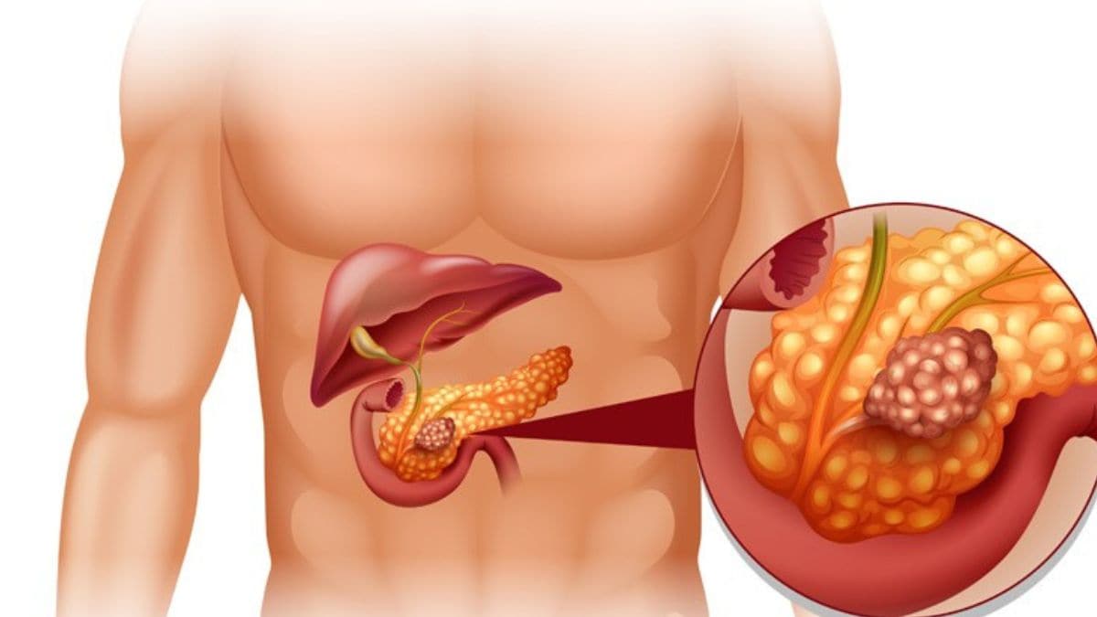 pancreatitis-rep - 1