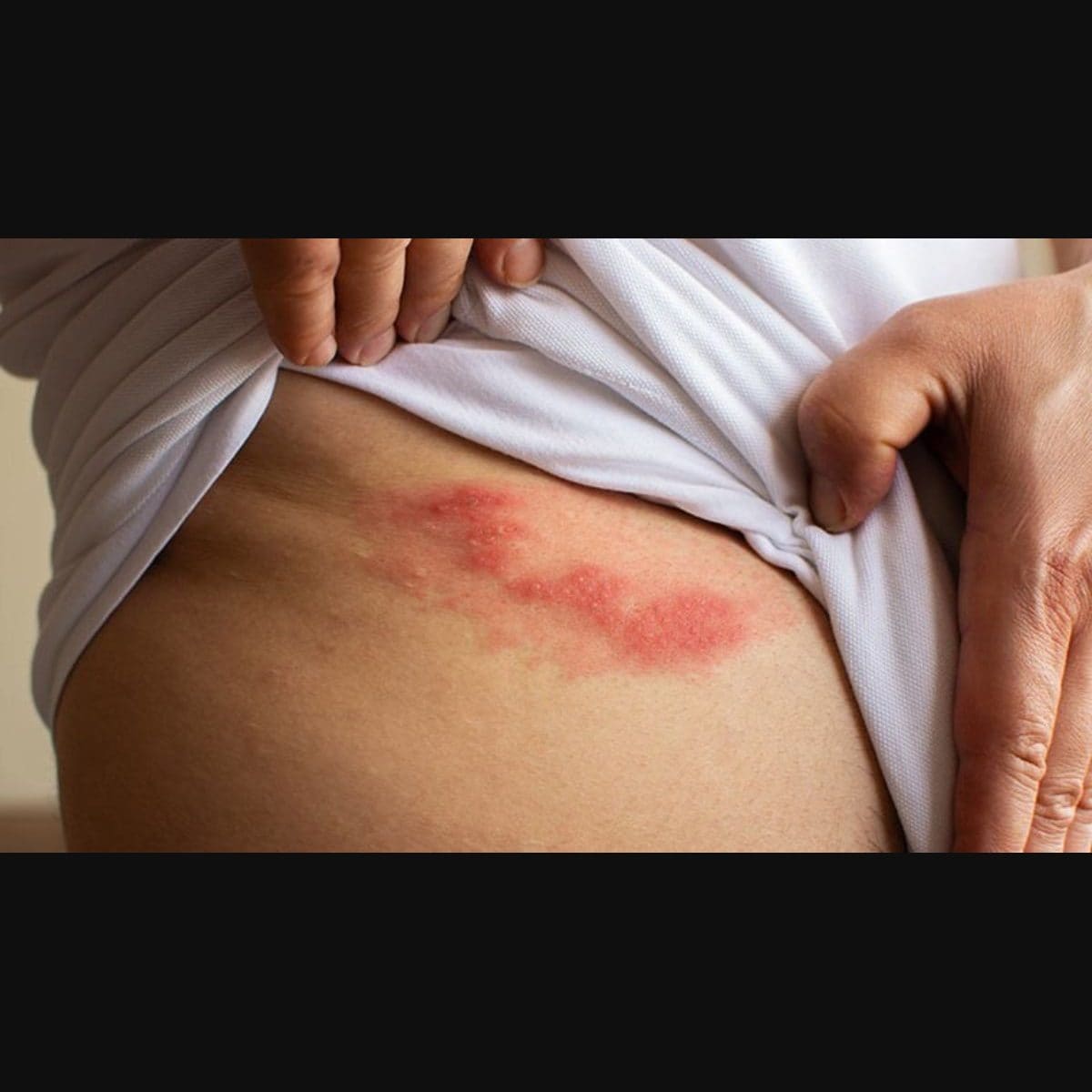 Why shingles increases the risk of stroke in older adults