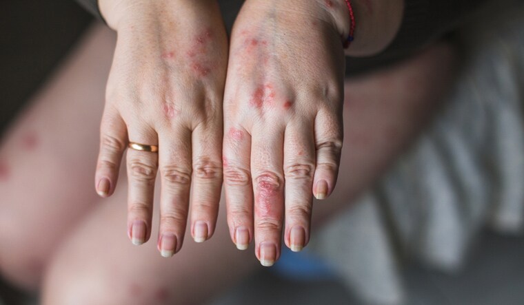 psoriasis-women