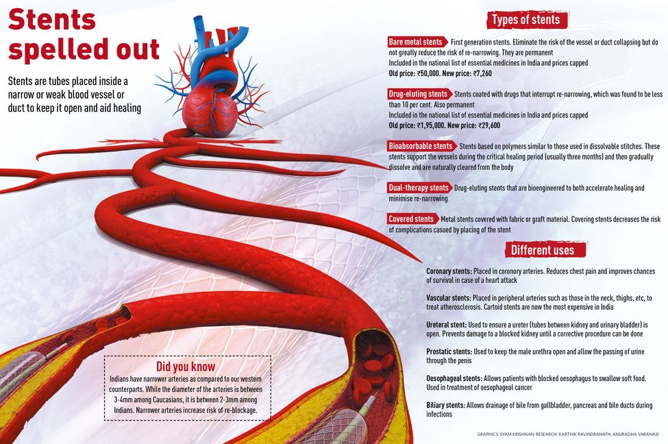 20-stents-spelled-out