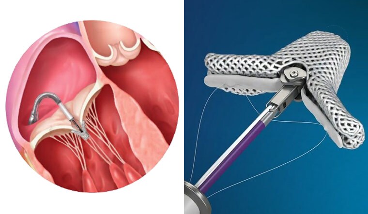 Innovative solution: MitraClip; (left) the clip in the tricuspid valve.