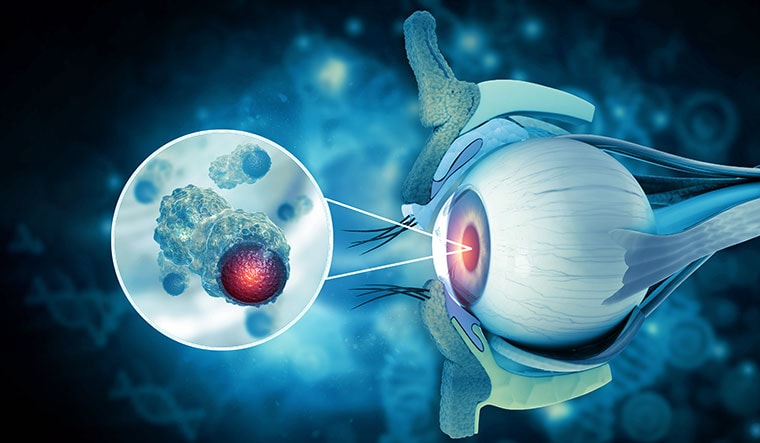 A representative image of an eye cancer.