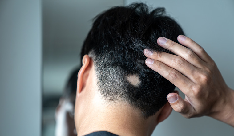 17hair-loss-drug-to-treat-alopecia-areata