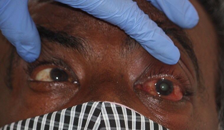 Keep an eye: Mucormycosis (black fungus) invading the left eye of a patient.
