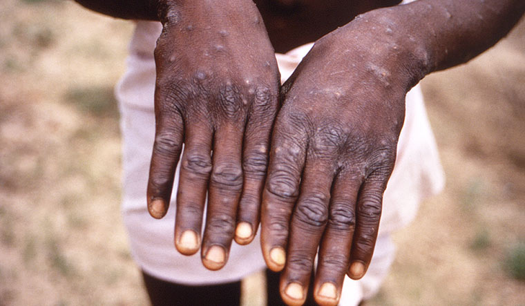 Rare human Monkeypox case identified in the USA - The Week