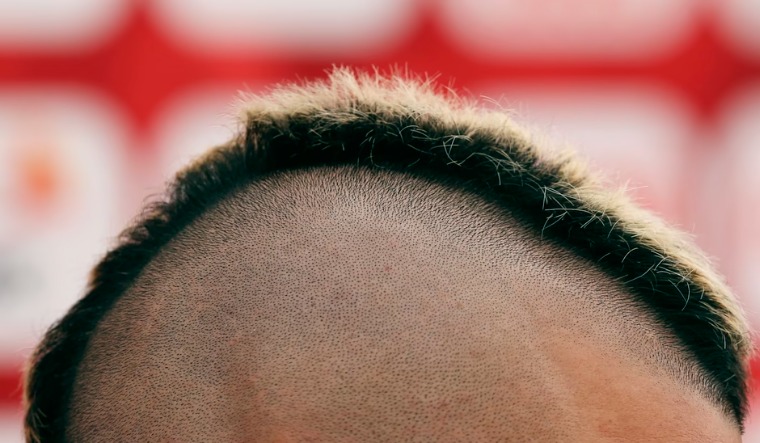 Alopecia-hair-Reuters