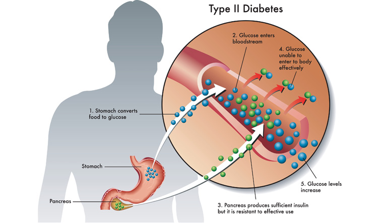 Medical illustration showing stress hormones affecting blood glucose levels in diabetes patients