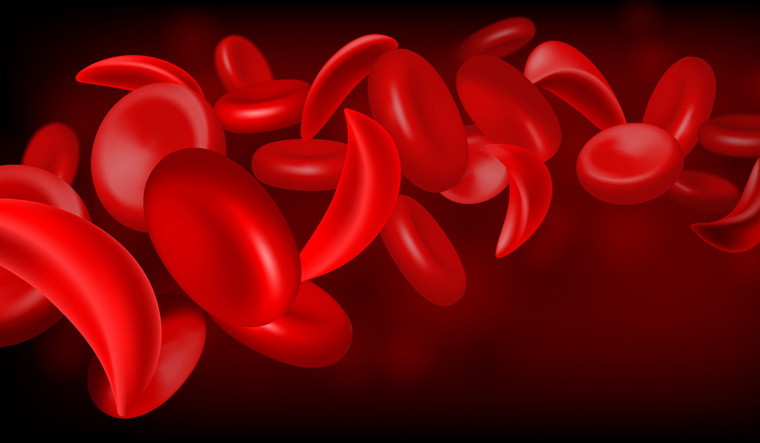 Sickle cell disease elimination