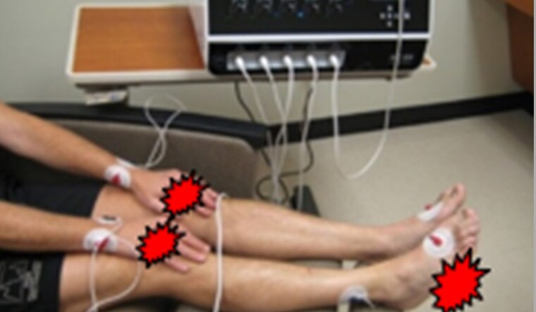 Scrambler-therapy-used-for-a-patient-with-chemotherapy-induced-peripheral-neuropathy-Photo-courtesy-of-Thomas-Smith