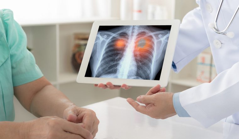 health-lungs-lung-x-ray-lung-disease-pulmonary-doctor-patient-shut