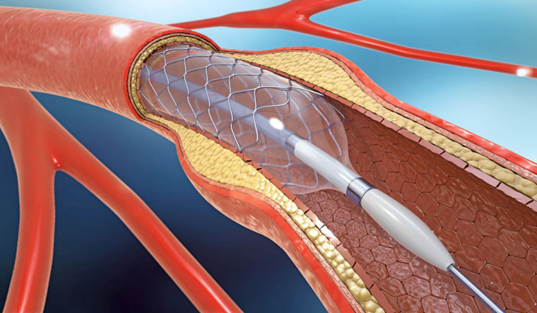 stent-implantation-for-supporting-blood-circulation-into-blood-vessels-3d-illus-shut