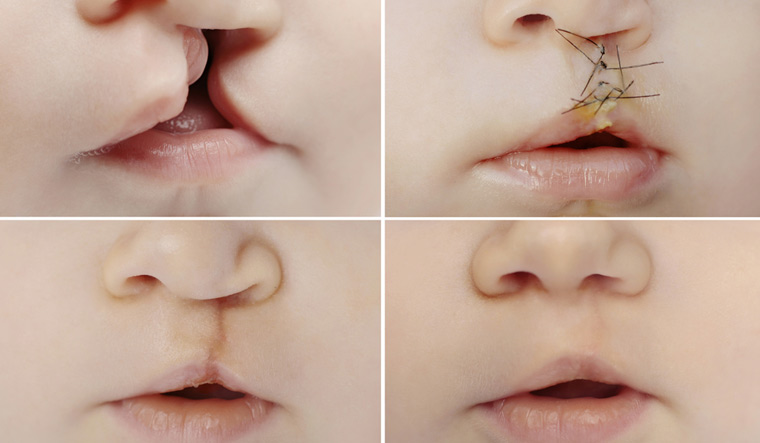 surgery-Cleft-lip-cleft-palate-face-facial-deformities-child-children-shut