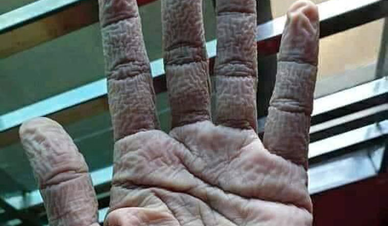 wrinkled-hand