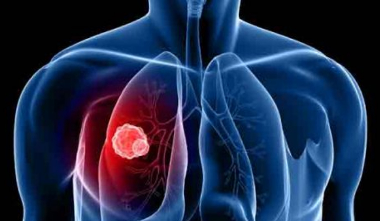 lungs-chronic-respiratory-desease-lung-reu