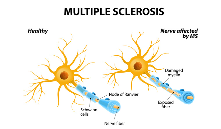 Multiple-sclerosis-MS-autoimmune-disease-shut