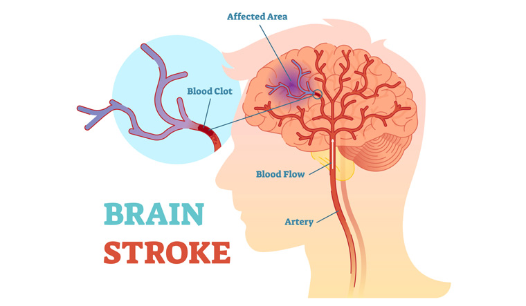 brain-stroke-head-blood-circulation-blood-clot-shut