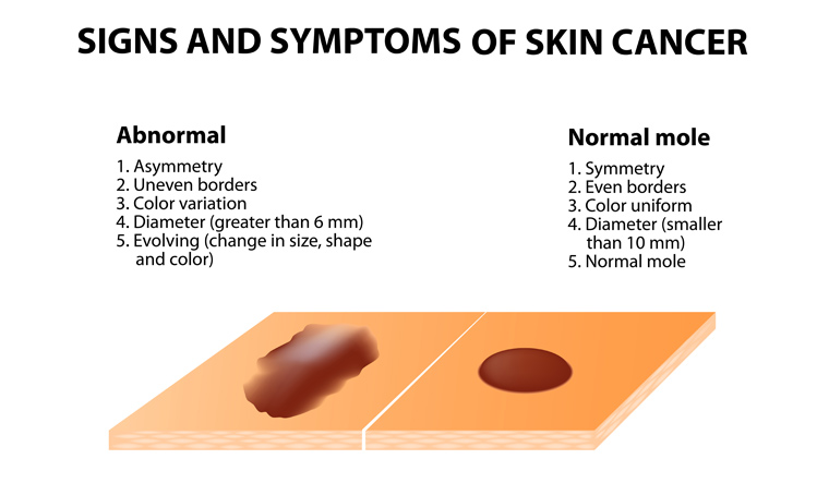 Anti-parasitic drug may be repurposed to fight skin cancer: Study - The ...