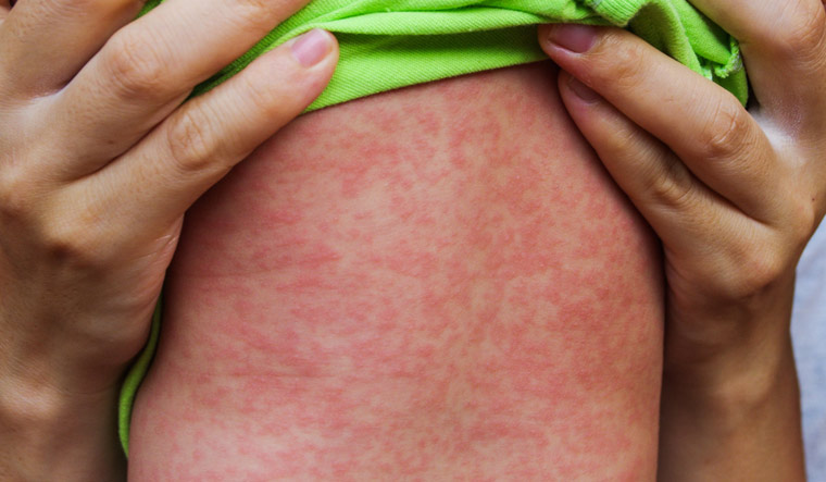 Measles-virus-Measles-rash-shut