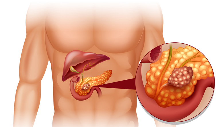 pancreatic-cancer-pancreas-human-shut