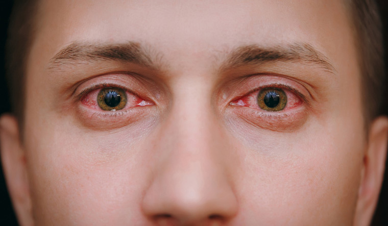 sore-eye-red-blood-eyes-virus-flu-conjunctivitis-cold-allergy-shut