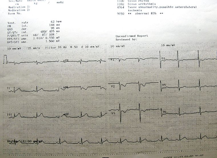 Heart burn: The first ECG that showed that Sean was having a major heart attack involving the inferior wall of the heart.