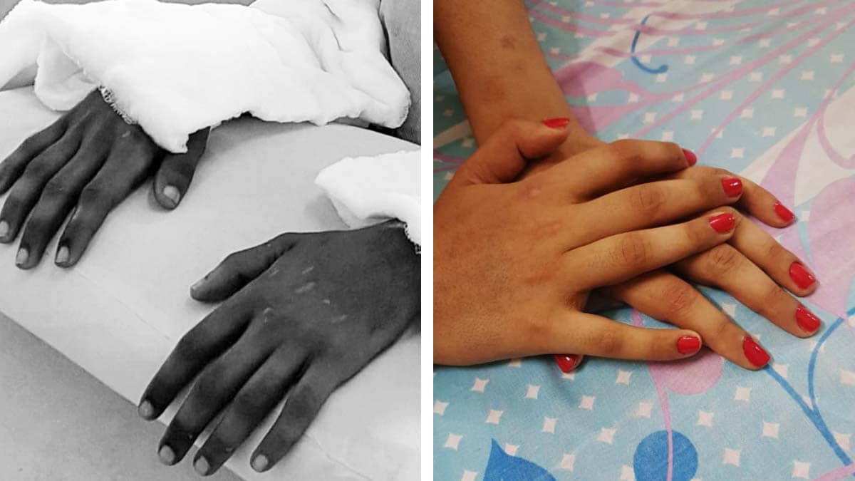 2017 Shreya Siddanagowder’s hands soon after the transplant - 2018 Shreya Siddanagowder’s hands after a year of rehabilitation