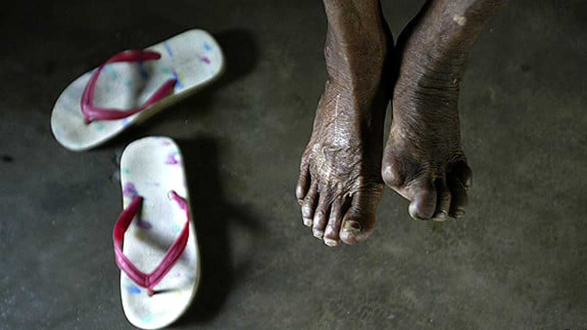 Experts say early diagnosis is the key to effective leprosy treatment | Reuters