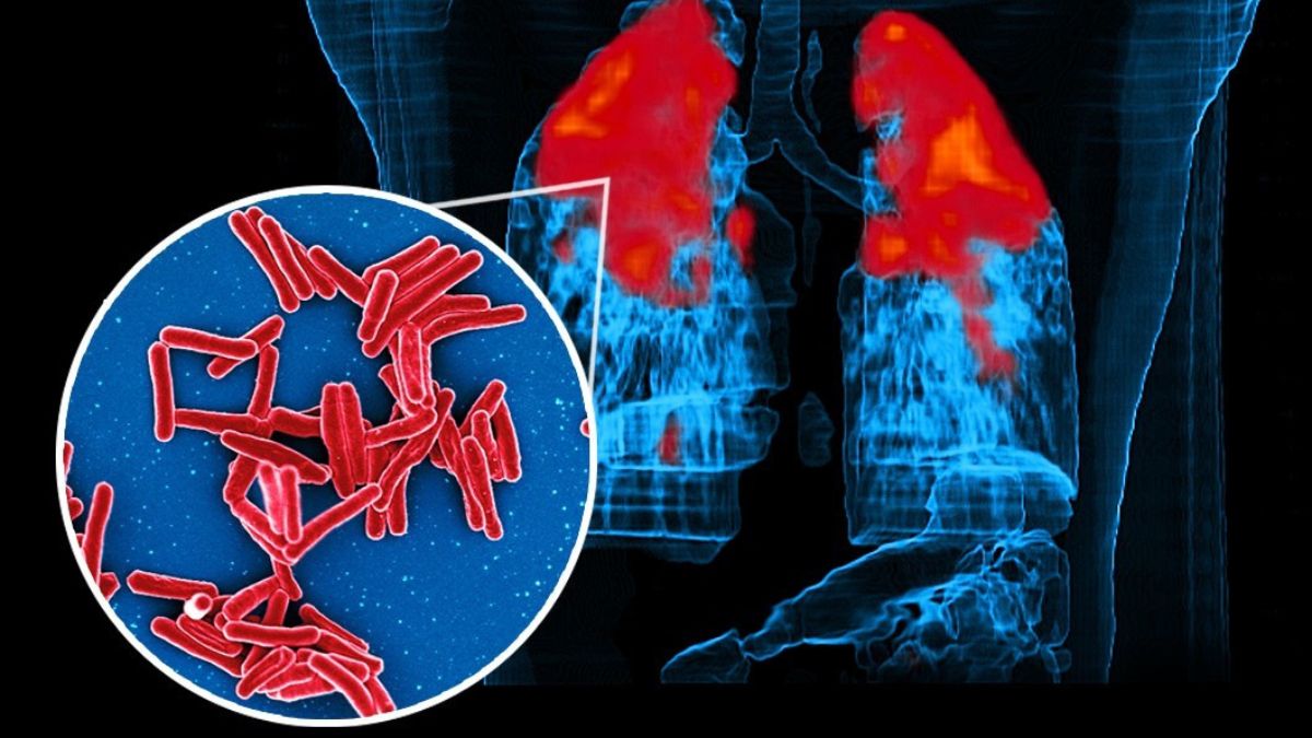 Mycobacterium Tuberculosis Bacteria, the Cause of TB. ​​​Credits: NIAID, CC BY 2.0, via Wikimedia Commons (cropped)