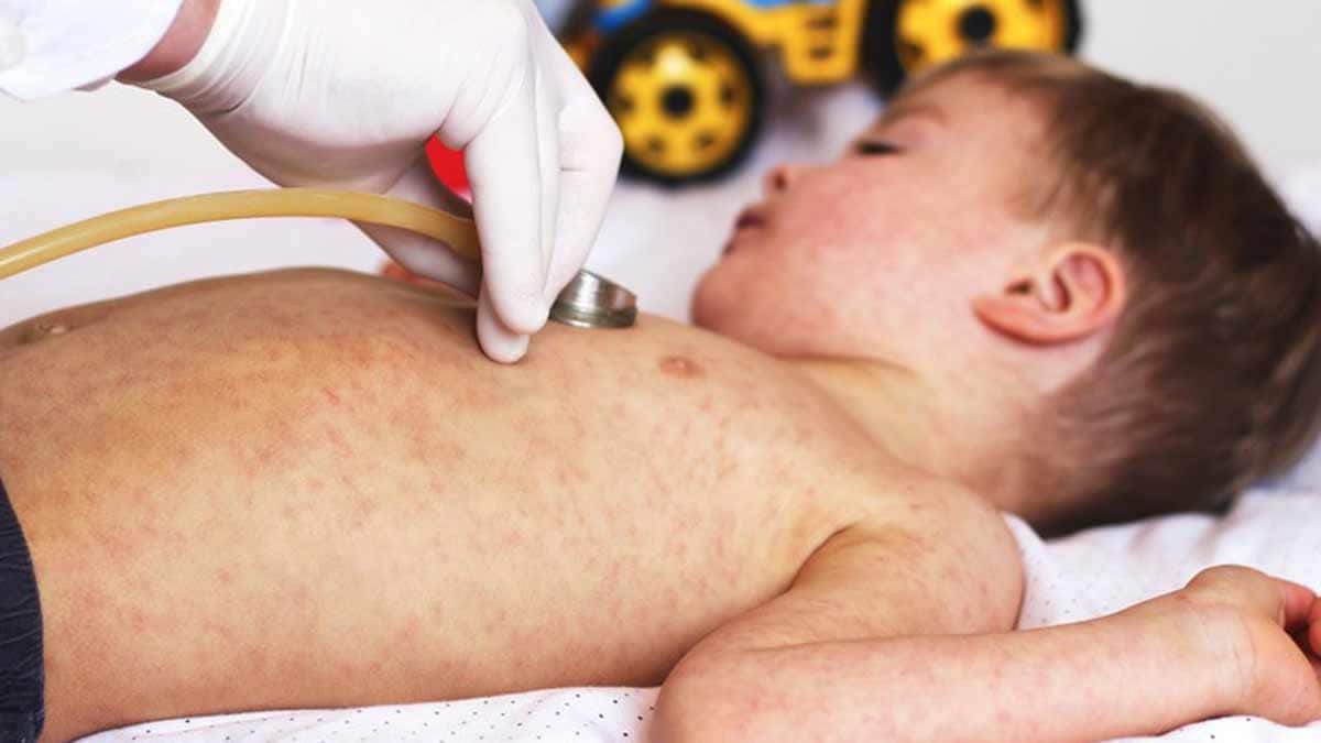 measles-outbreak-afghanistan