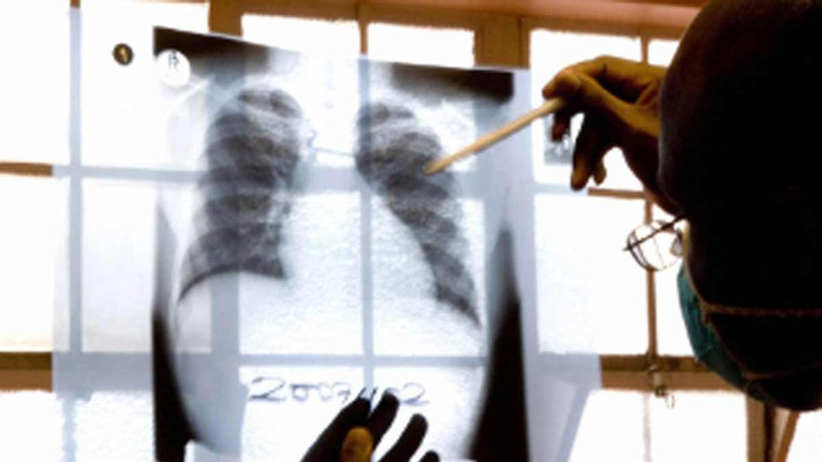 tuberculosis-240325