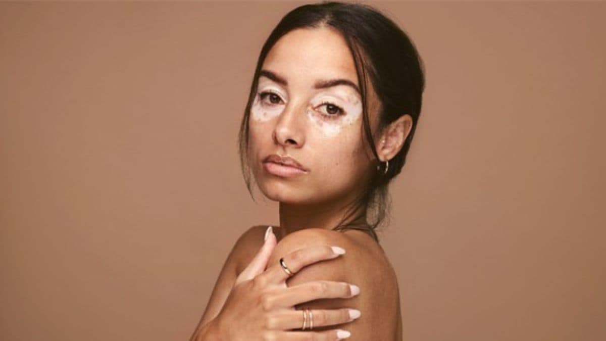 World-Vitiligo-Day - 1