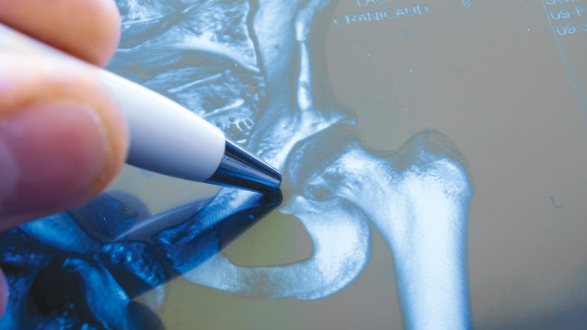 an-alternative-to-hip-replacement-birmingham-hip-resurfacing - 1