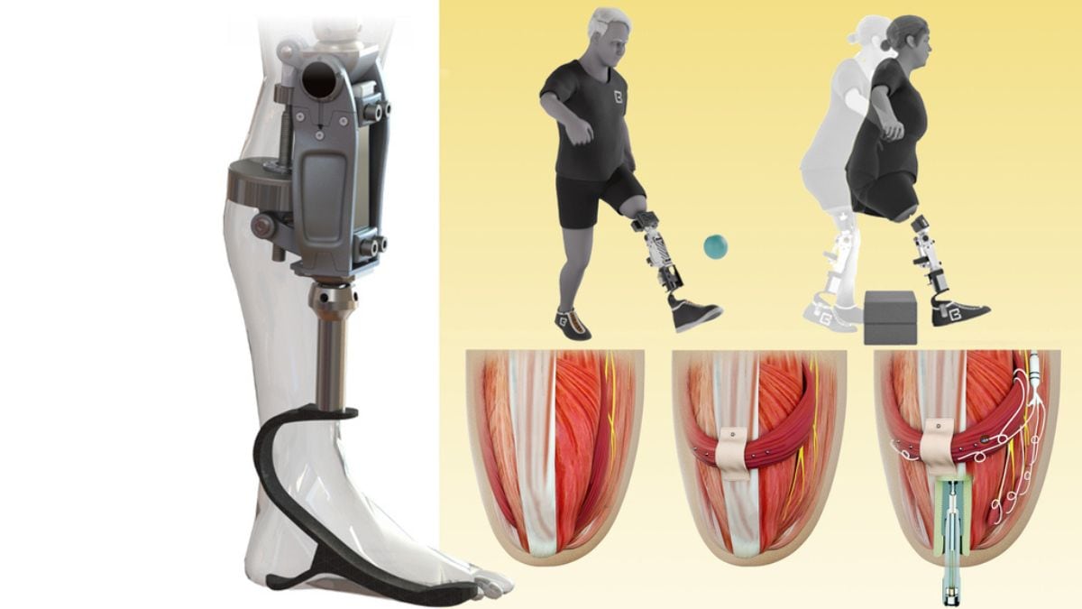 MIT-bionic-knee - 1