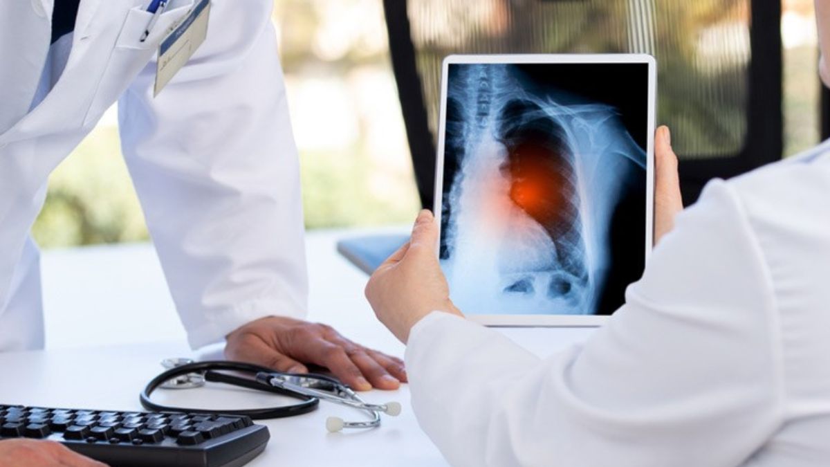 Lung-cancer - 1