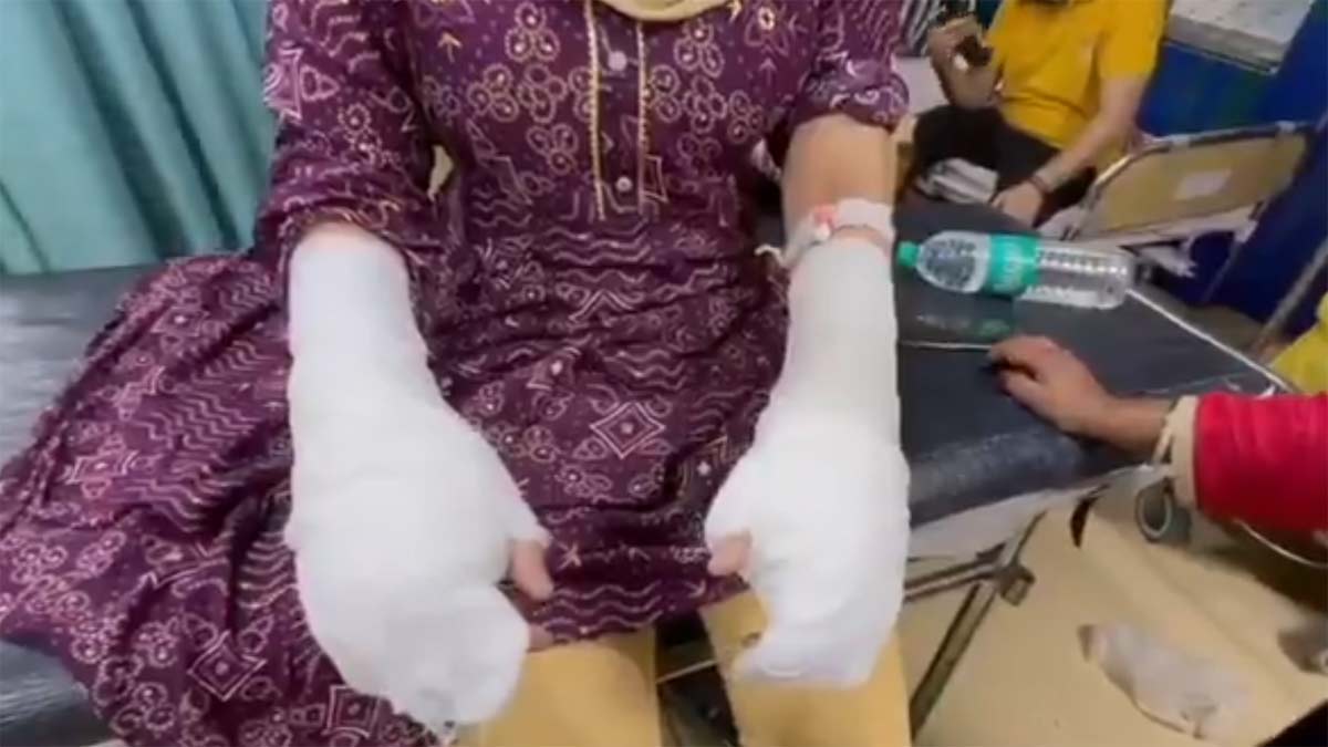 Delhi acid attack hoax: DU student used toilet cleaner; father arrested ...
