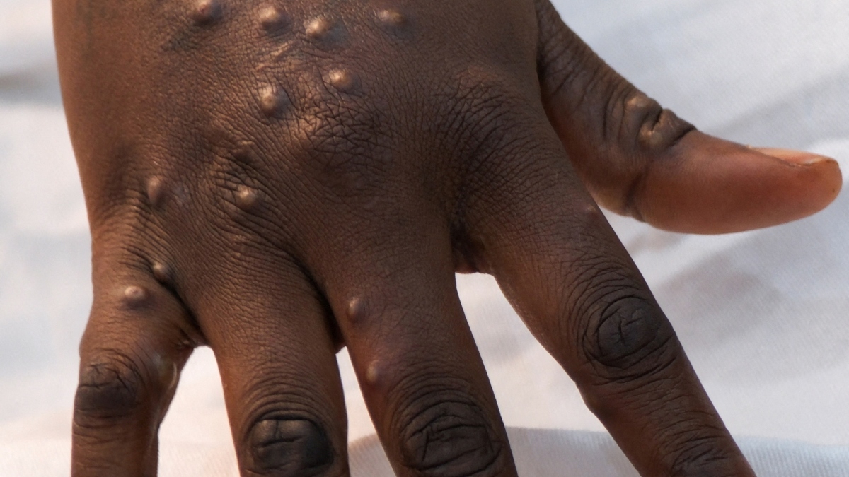 Mpox virus of West African clade-2 confirmed in India: Health Ministry