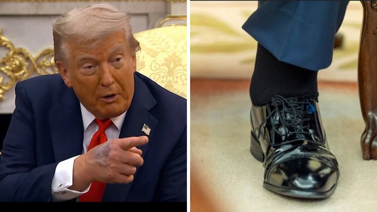 The bruise on Trump's hands.(Right) His swollen ankles | X 